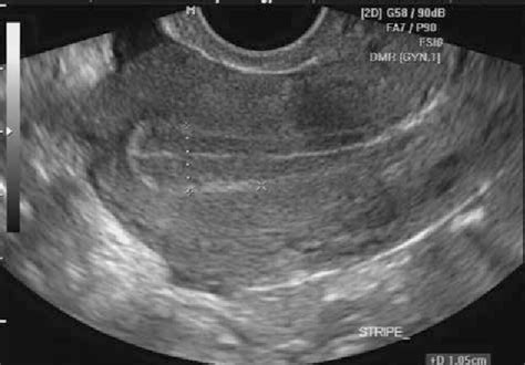 trilaminar endometrium ultrasound images